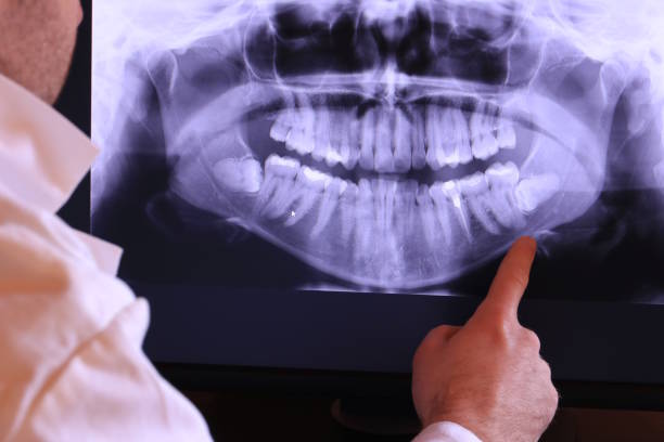 Best Emergency Tooth Extraction in Tye, TX