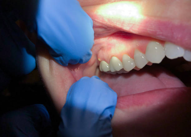 Best Emergency Gum Treatment in Tye, TX